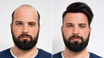 Hair Patches - Best Men Hair Patches In Bangalore