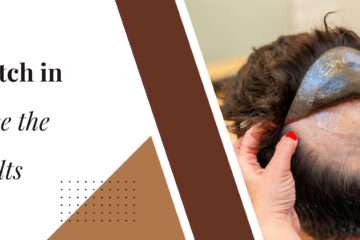 Best Hair Patch in Bangalore: How to Choose the Right One for Natural Results (2026 Guide)